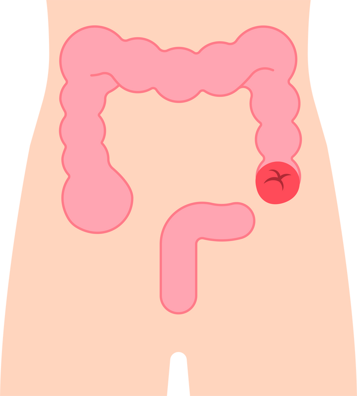 Irritable Bowel Syndrome inflammatory disease large intestine colorectal ulcerative colitis