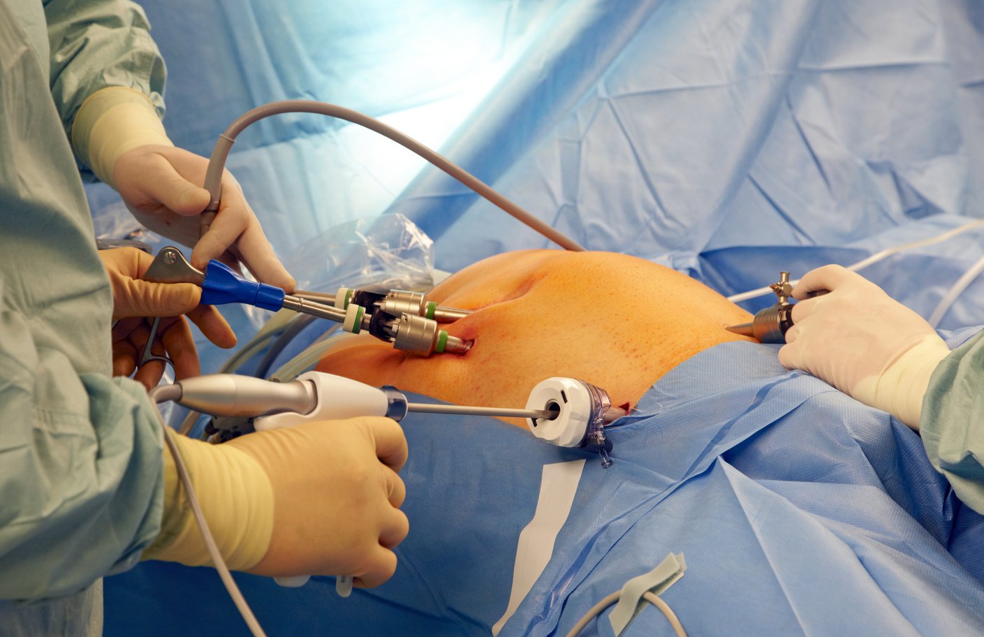 Laparoscopic surgery