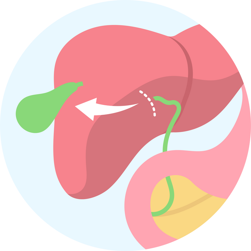 bile duct liver small intestine cancer tumor polyp pain pancreas tract stone infection obstruction blockage cyst hepatitis A B C