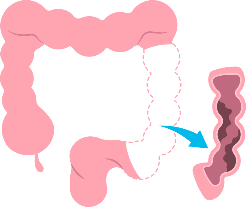 surgery treat stoma belly Hernia bowel tumor  stomach ileostomy bag ulcerative syndrome crohn's Irritable polyp proctocolectomy colitis  prolapse large colonic inertia