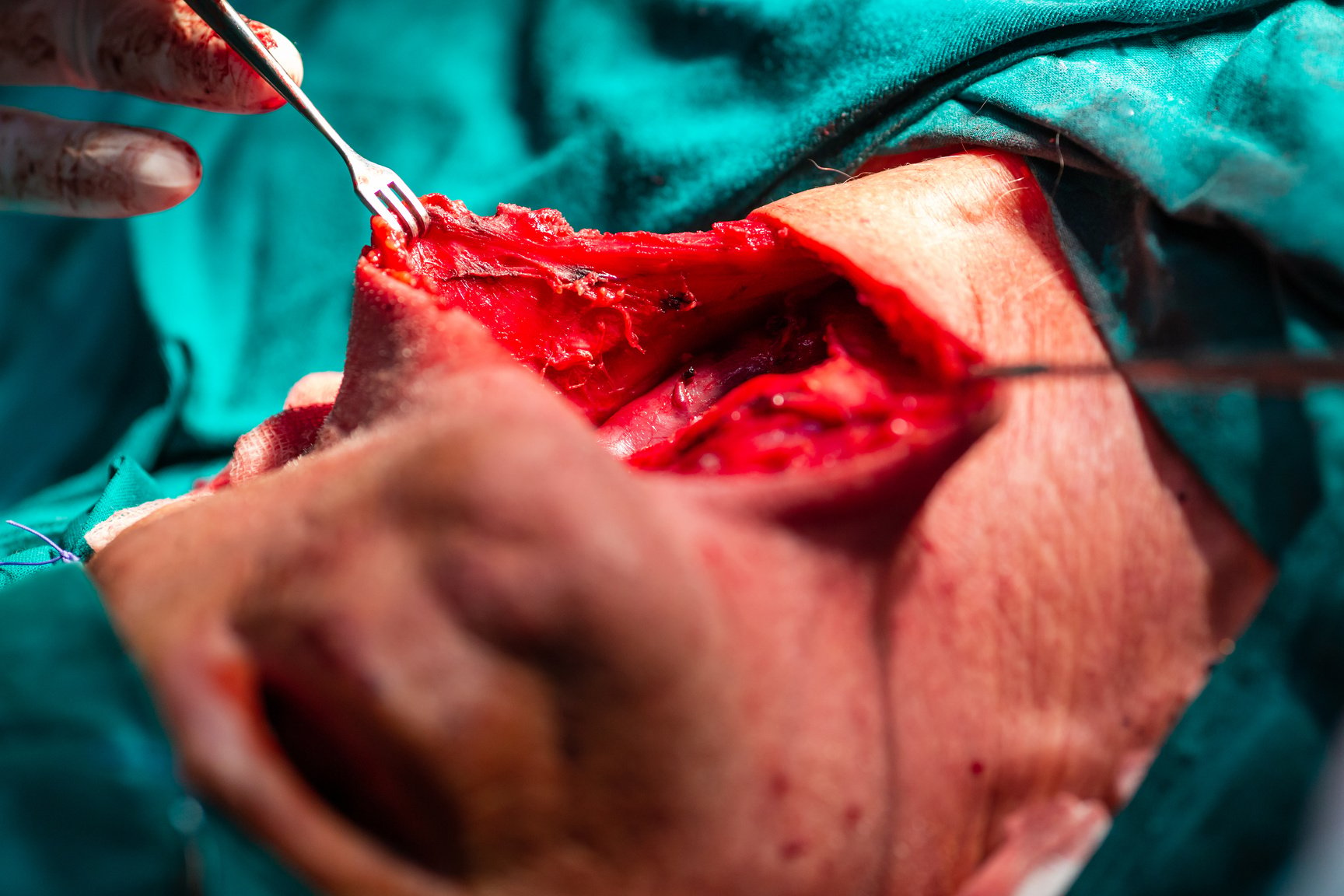 Carotid artery neck surgery