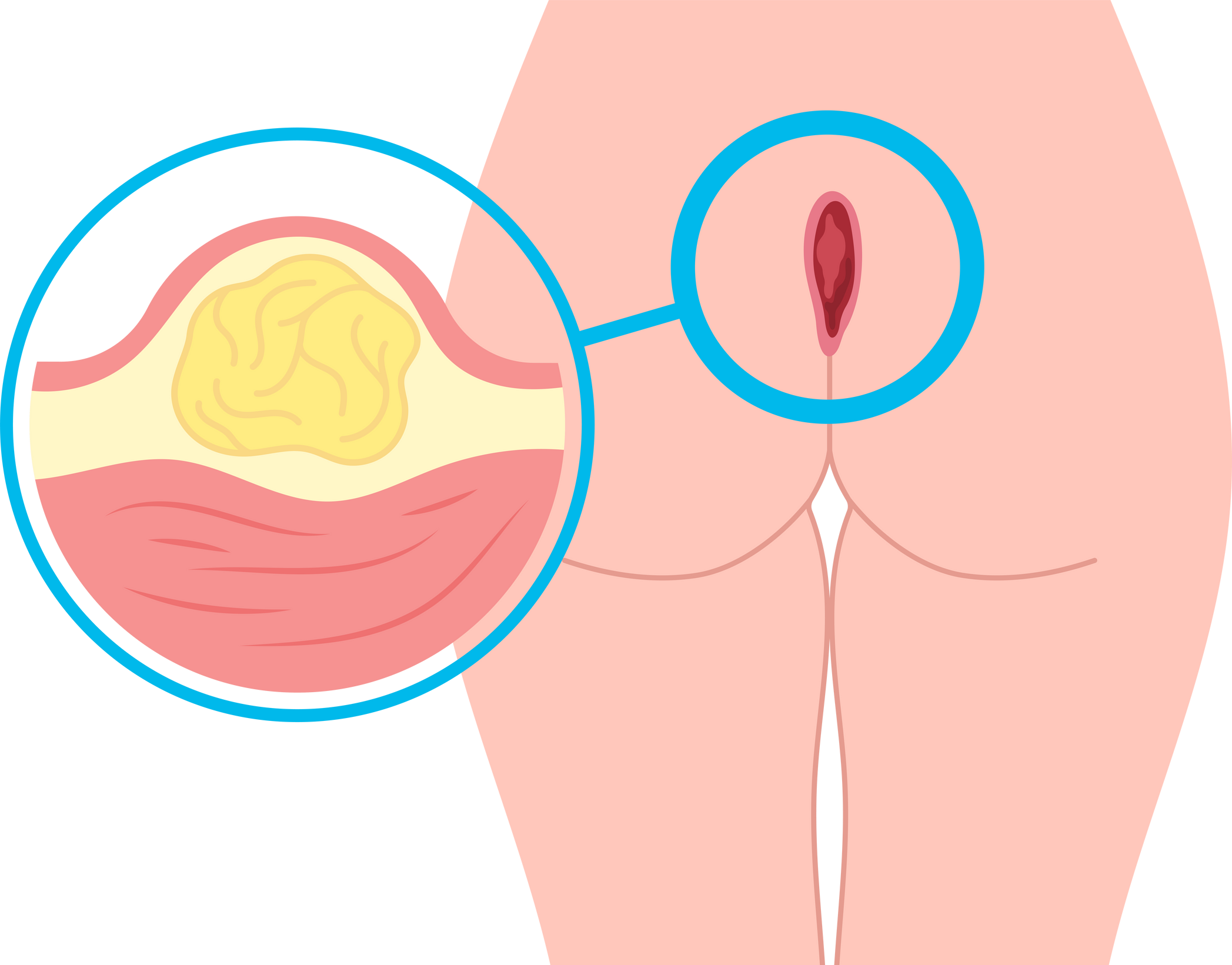 infected Inflamed sacral dimple