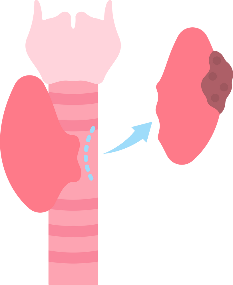 incision minimally invasive parathyroid hormone hypothyroidism enlarged hyperthyroidism larynx pituitary swelling enlarged infection endocrine lymph node biopsy Iodine deficiency system Thyroiditis