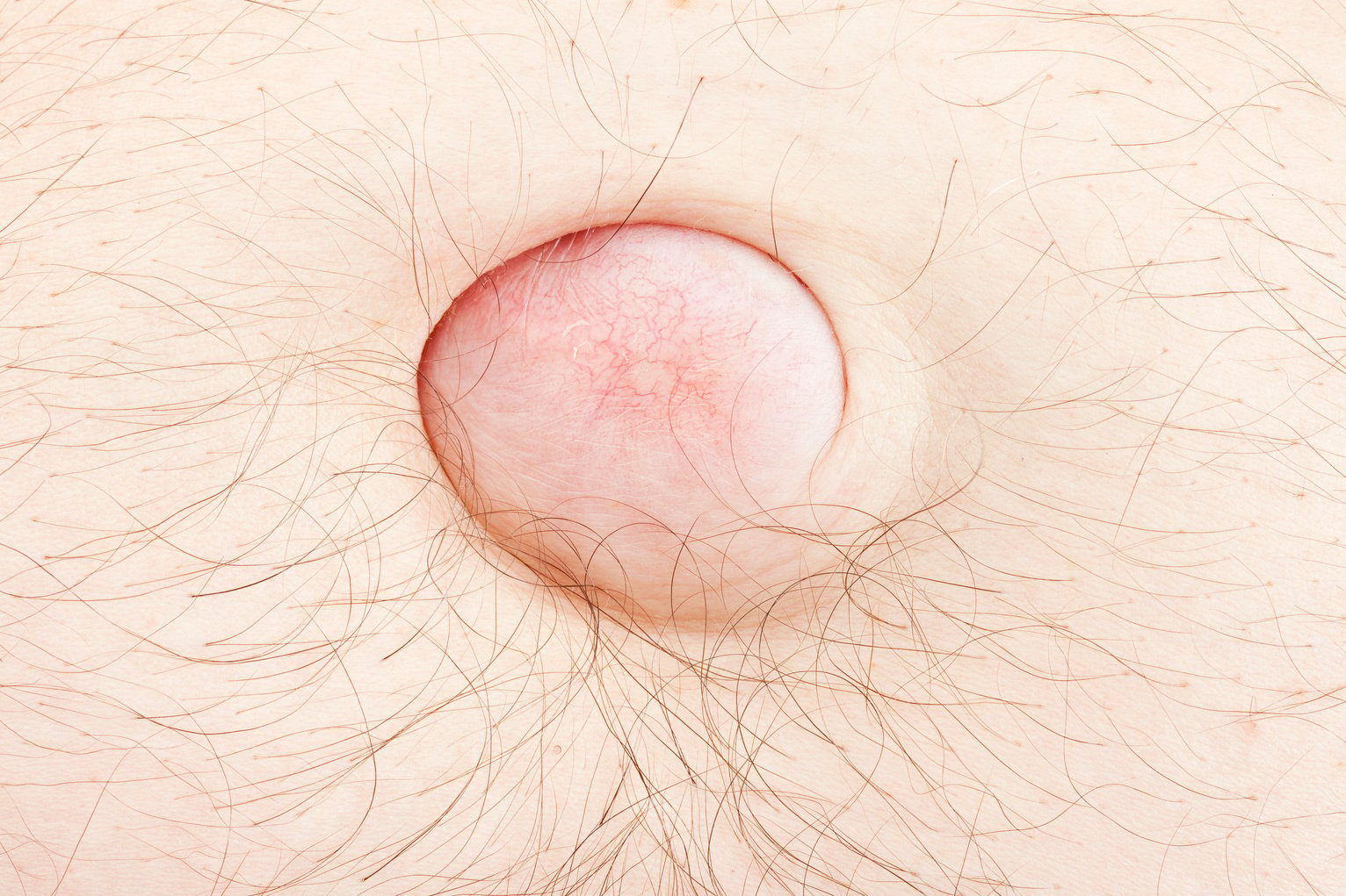 Hernia - Belly Button