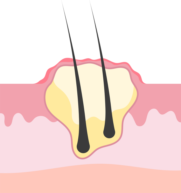 cyst skin cancer boil staph pain pus swollen under the hair follicle aureus MRSA tissue layer bacterial